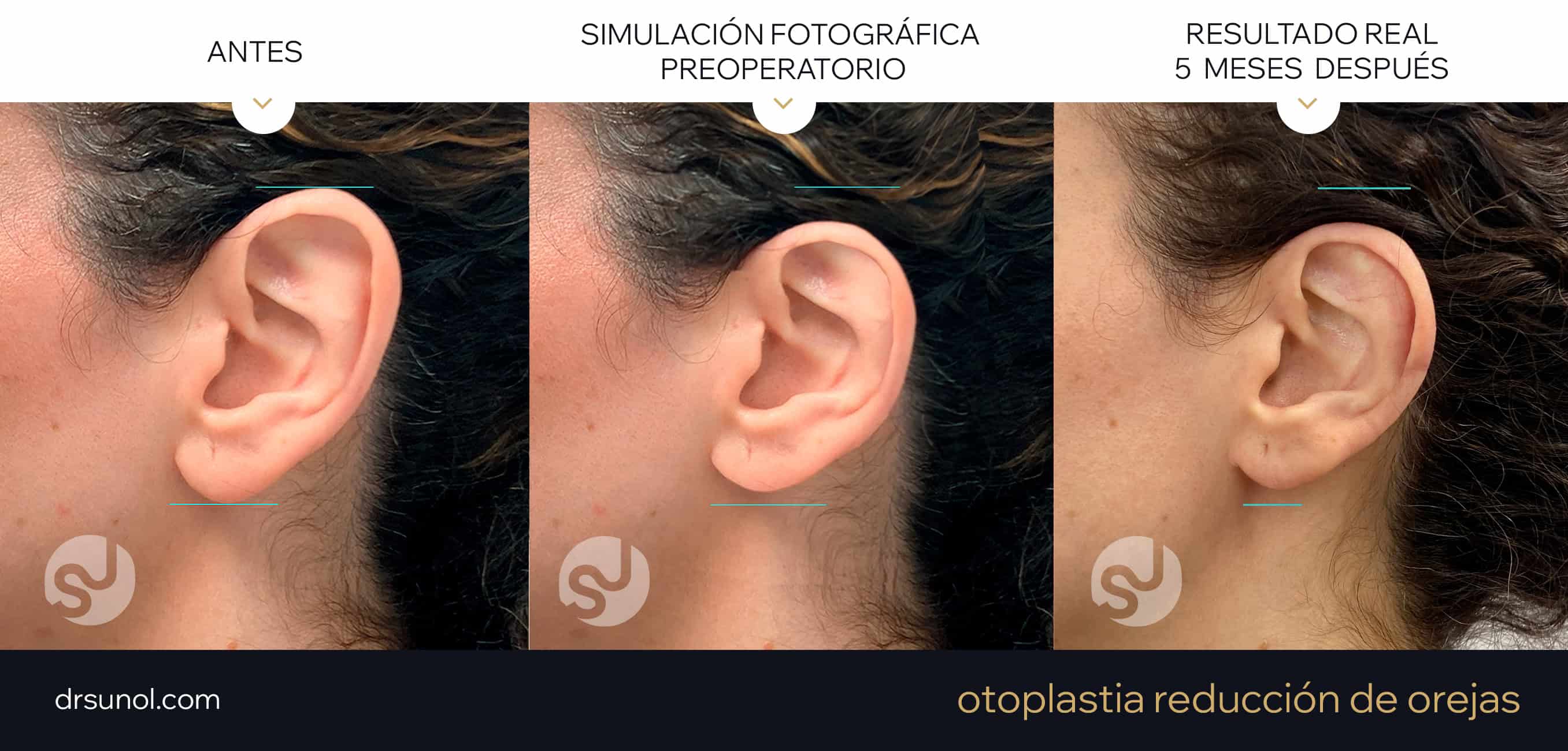 Ejemplo de reduccion de orejas