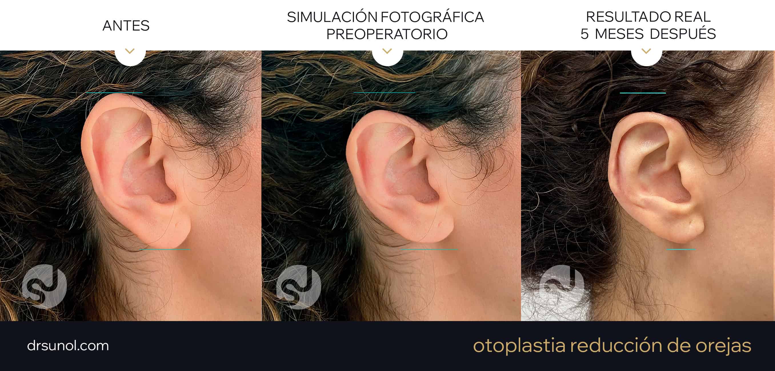 Ejemplo de reduccion de orejas