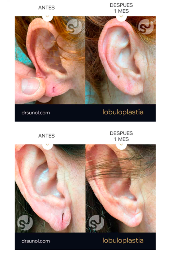 Antes y despues Lobuloplastia