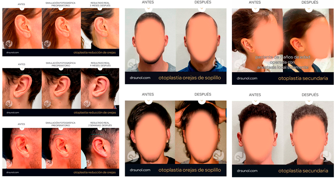 Imagenes de Antes y Despues de Otoplastia