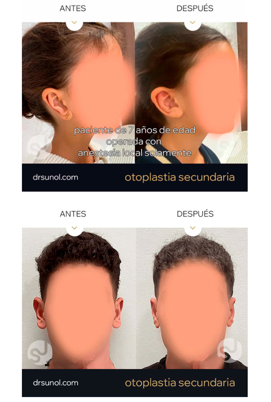 Antes y despues Otoplastia Secundaria