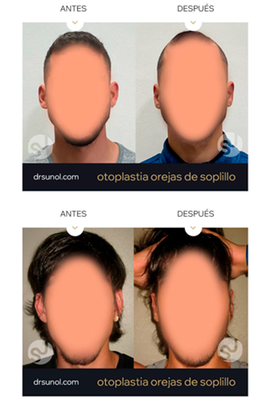 Antes y despues Otoplastia Orejas Separadas
