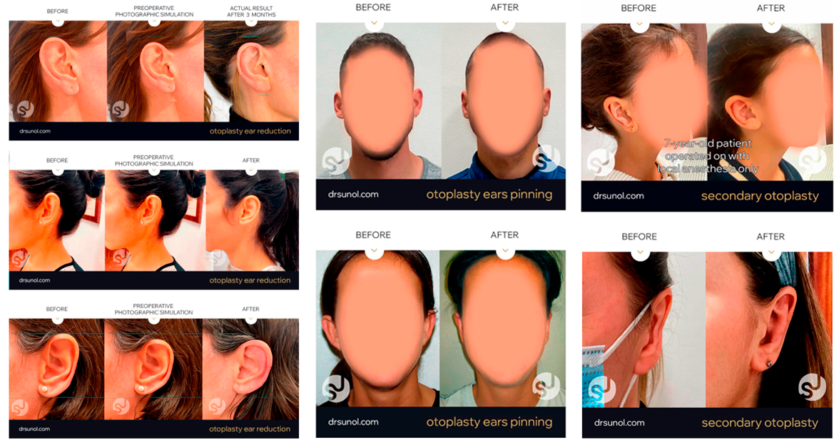 Before & After Otoplasty Results