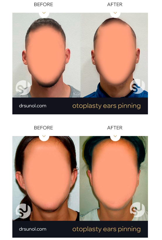 Results Before & After Protruding Otoplasty Ear Pinning