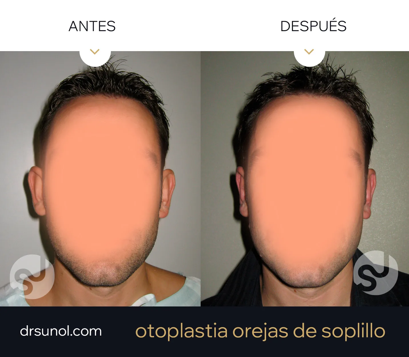 Orejas separadas antes y despues Orejas separadas antes y despues