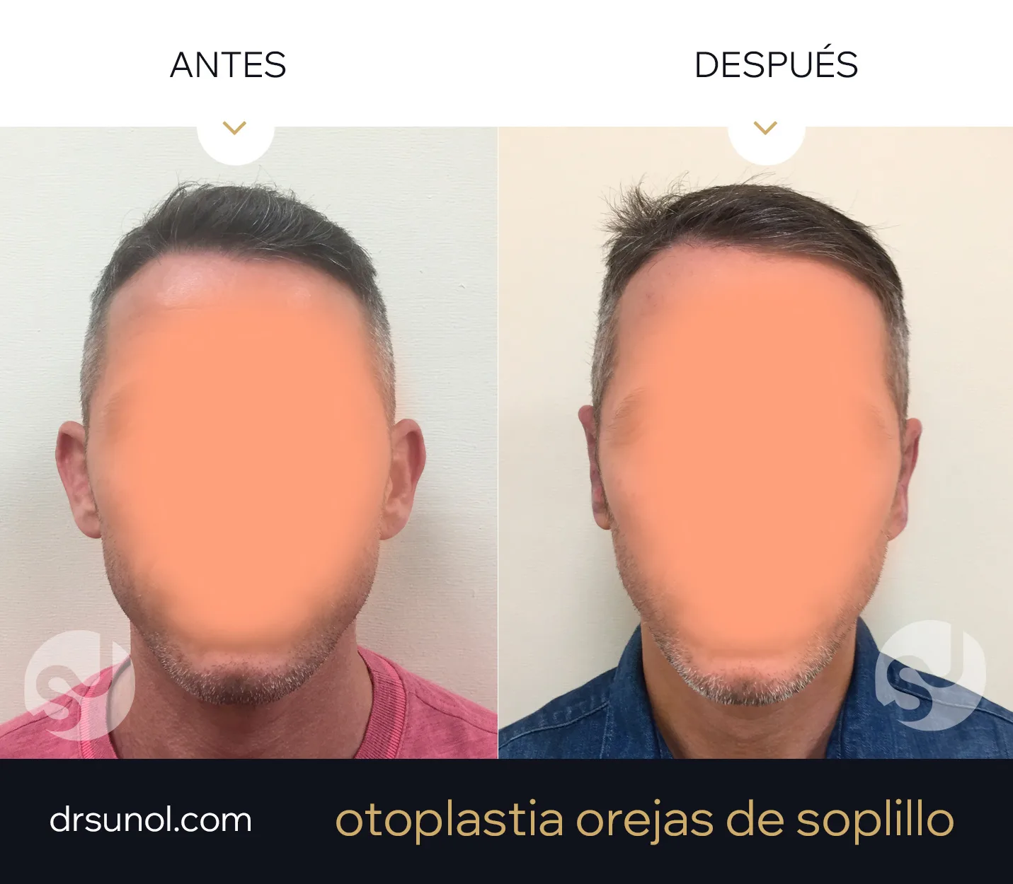 Orejas de soplillo antes y despues Orejas de soplillo antes y despues