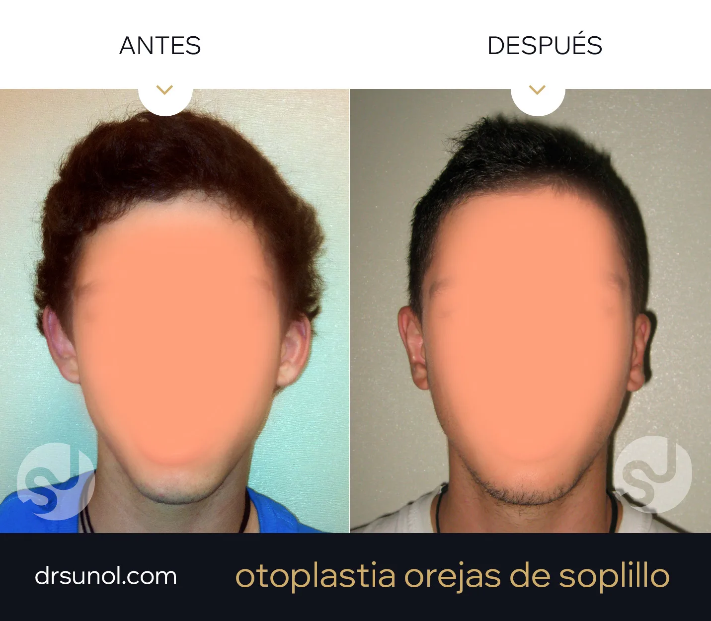 Orejas diferentes resultados operacion Orejas diferentes resultados operacion