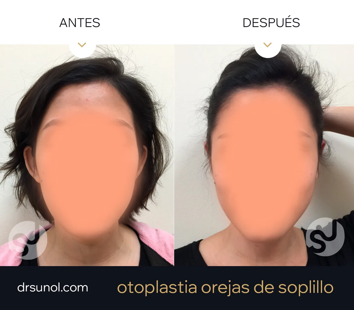 Otoplastia orejas en copa Otoplastia orejas en copa