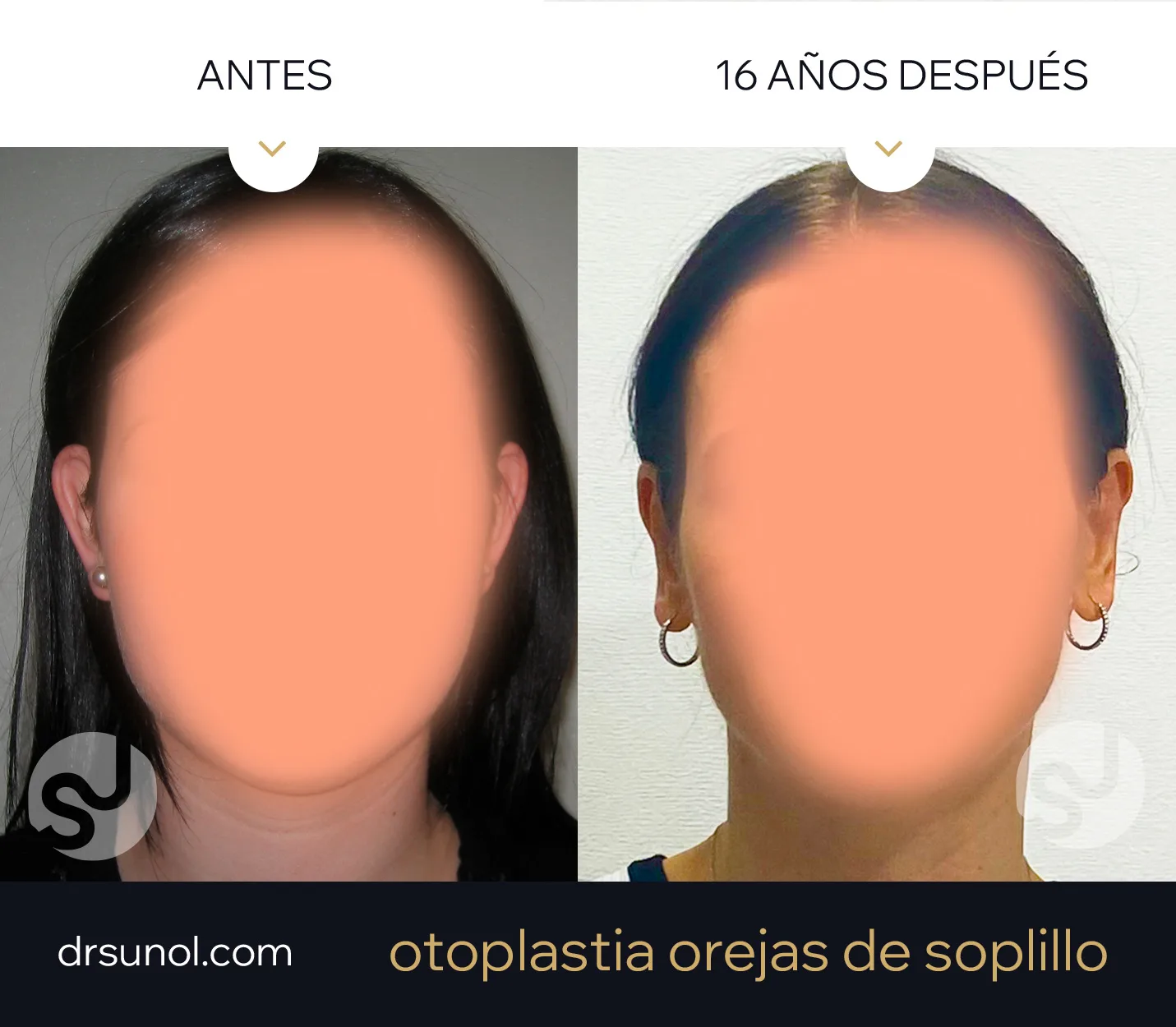 Otoplastia años despues Otoplastia años despues