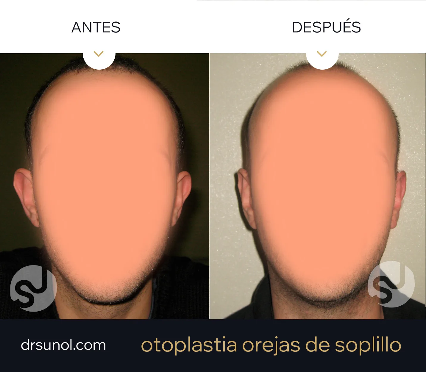 Otoplastia acercar orejas ejemplo resultados Otoplastia acercar orejas ejemplo resultados