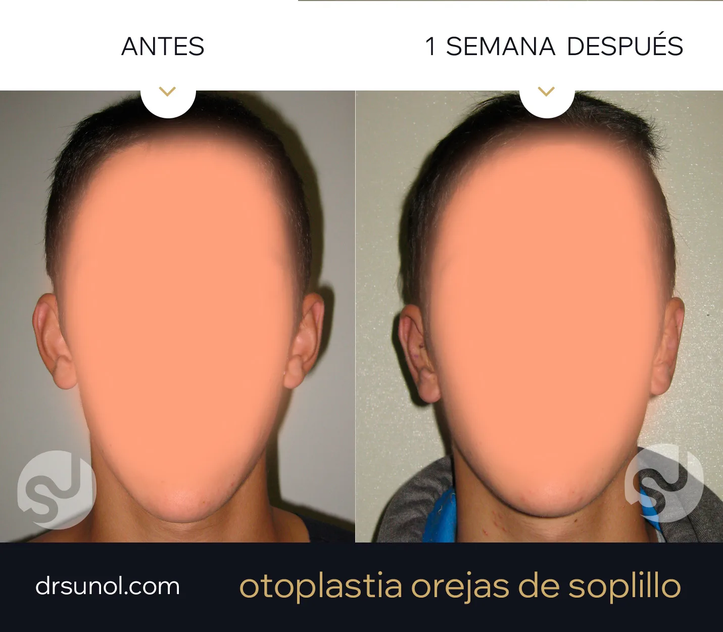 Otoplastia ejemplo resultados Otoplastia ejemplo resultados
