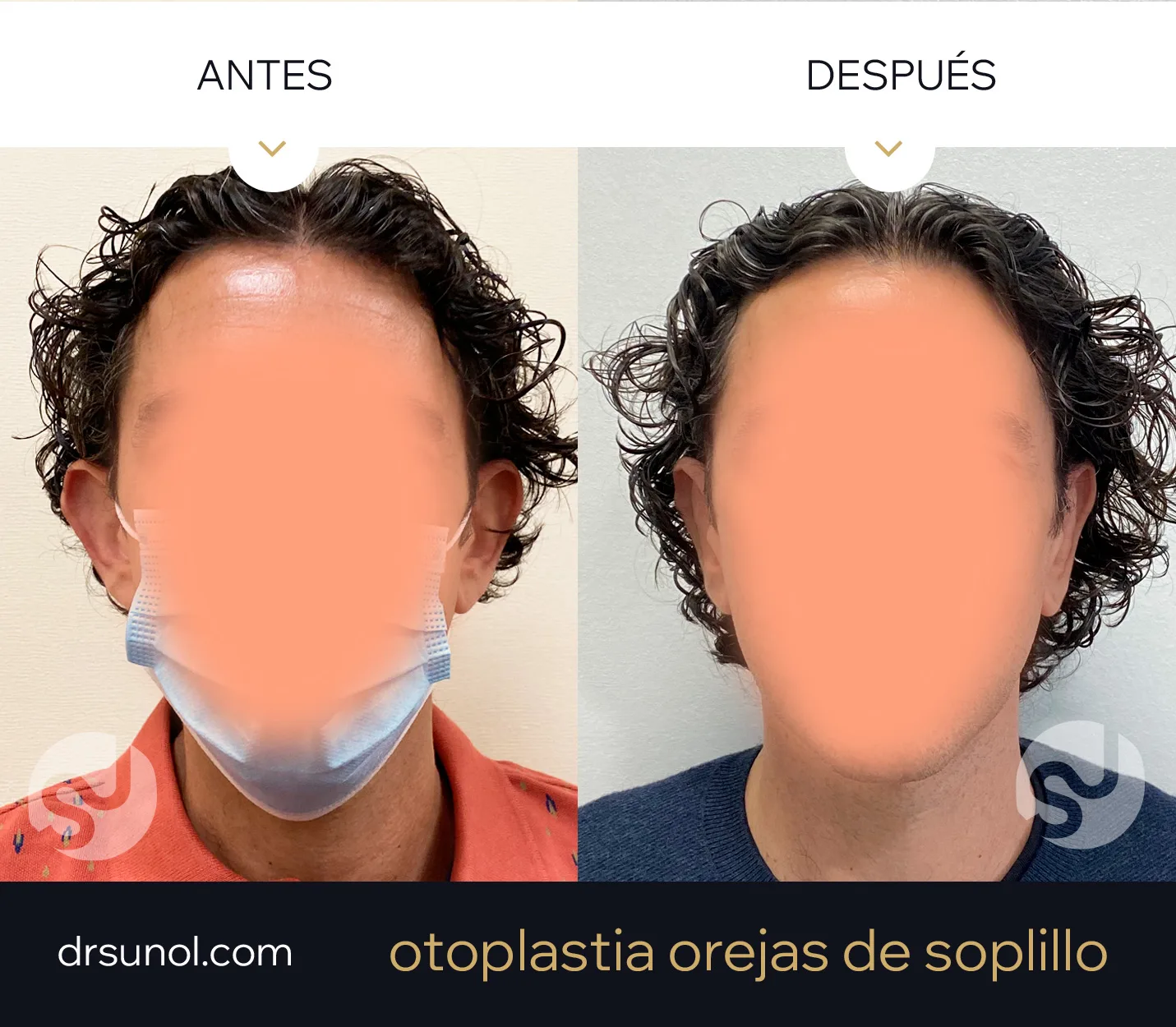 cirugia orejas separadas de soplillo antes y después cirugia orejas prominentes en soplillo antes y después