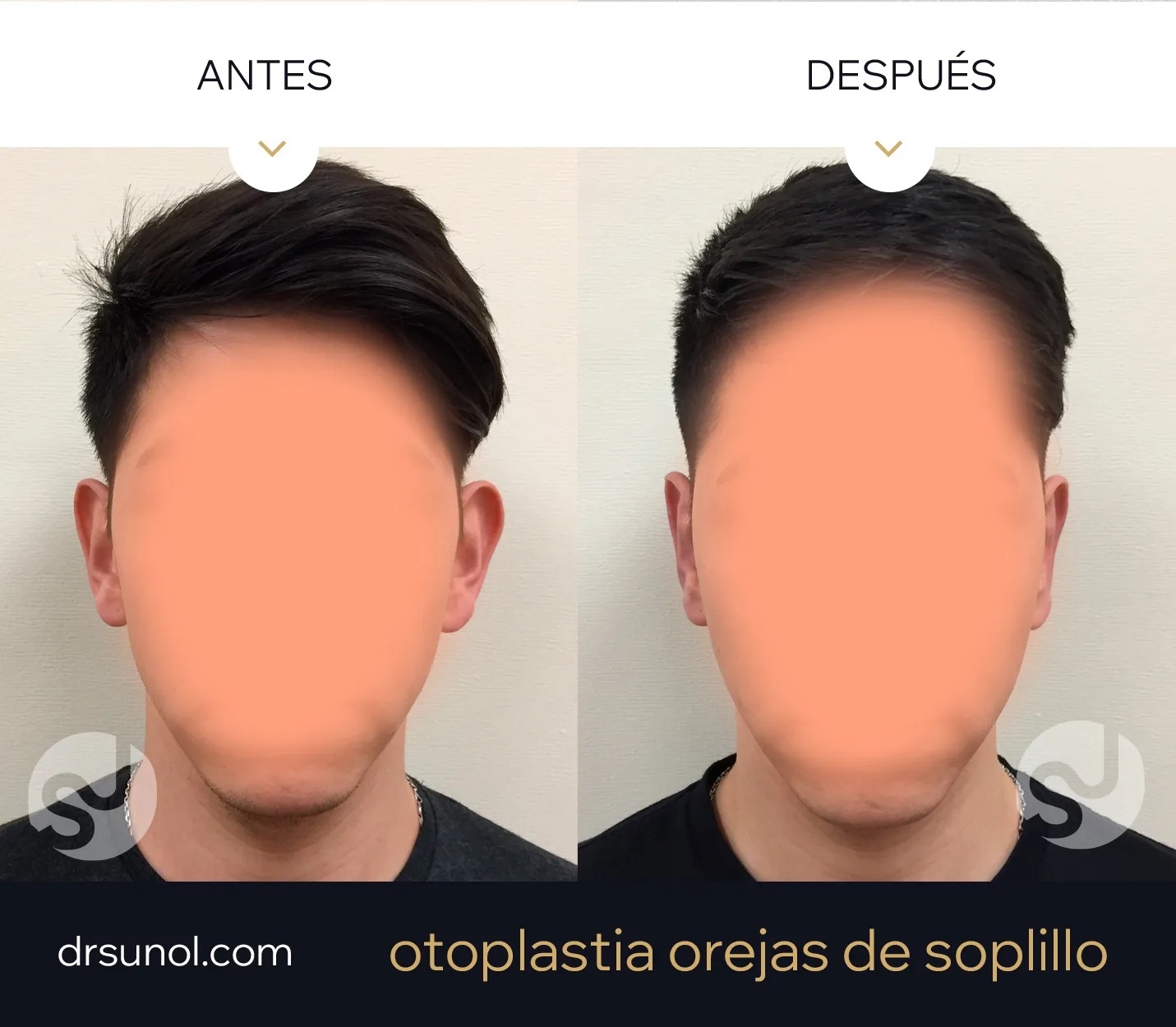 Otoplastia Antes Despues Otoplastia Antes Despues