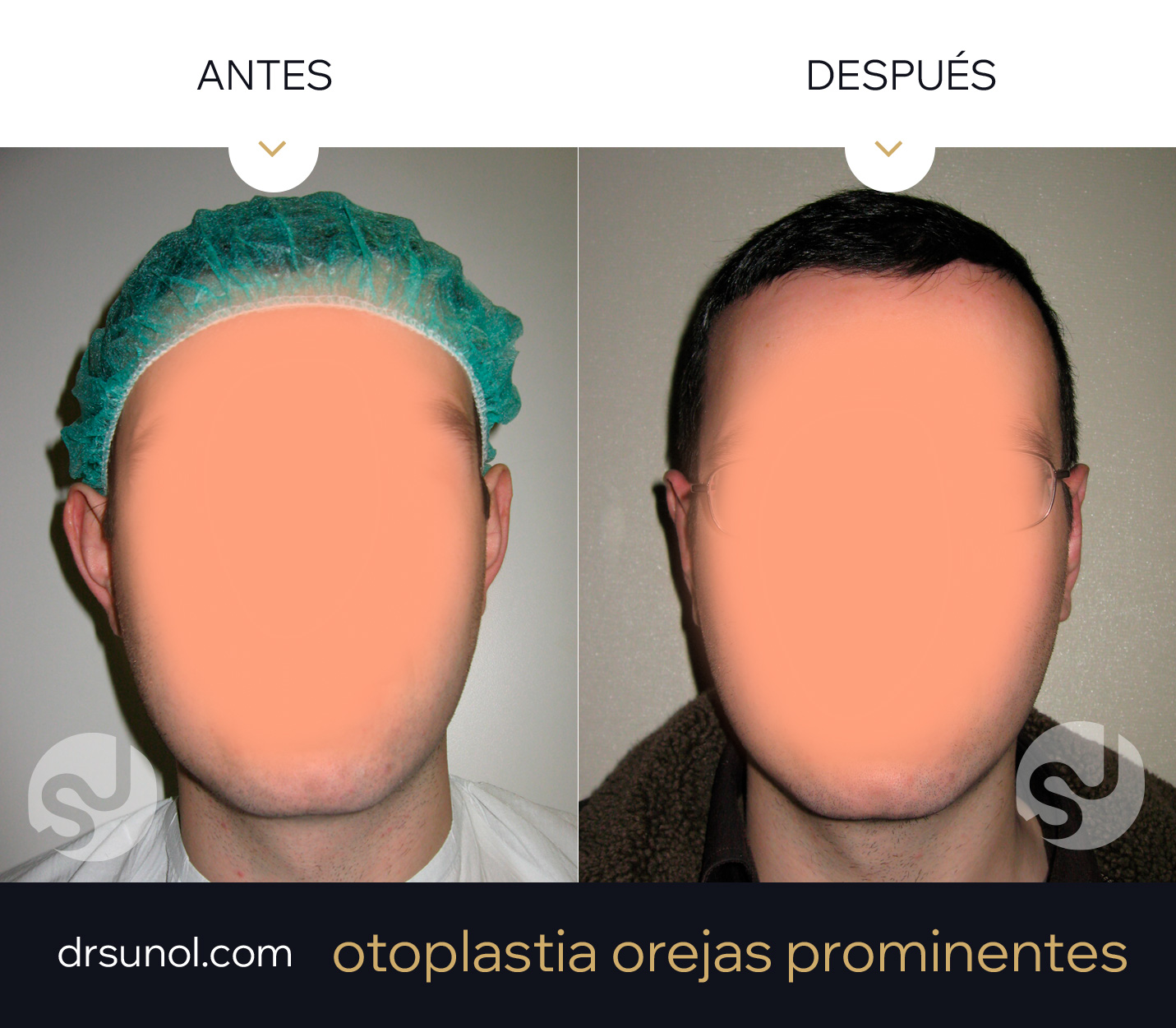 orejas diferentes antes y después