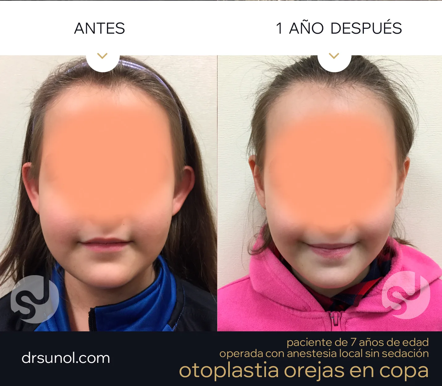 otoplastia niña resultado otoplastia niña resultado