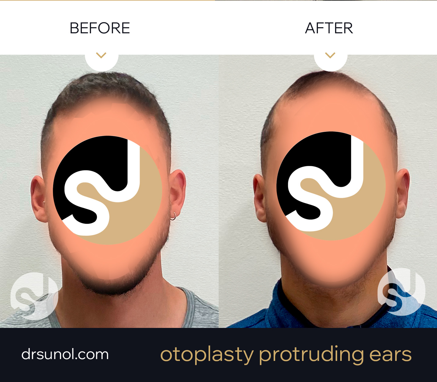 drsunolcom-patient-003 – copia Otoplasty Protruding Ears Before After