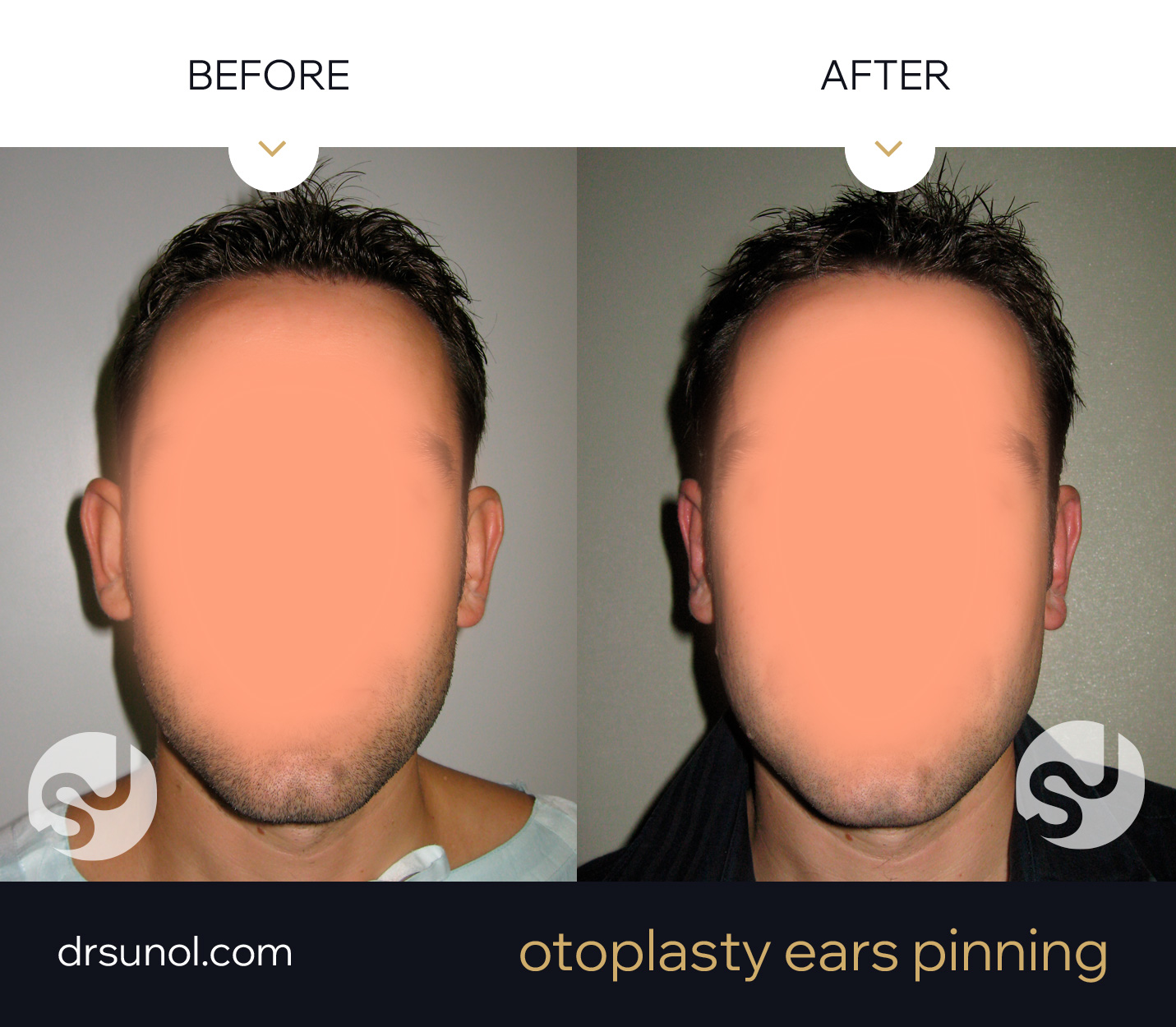 Otoplasty Results Before After