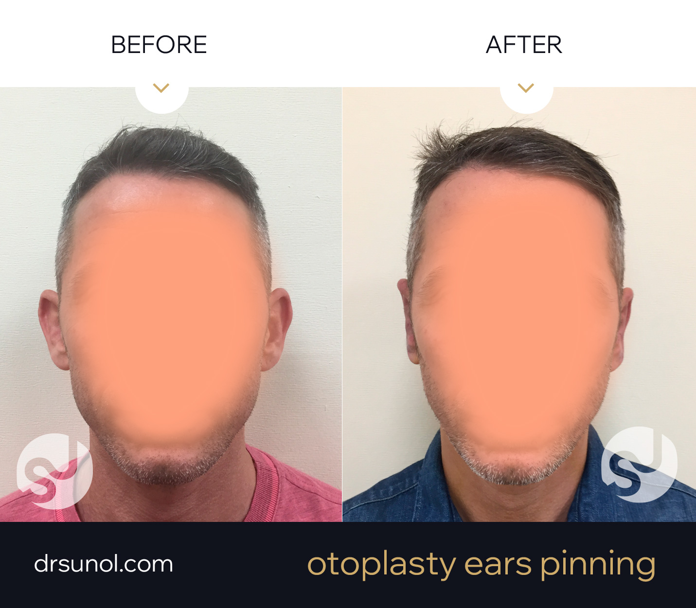 Otoplasty Results Before After