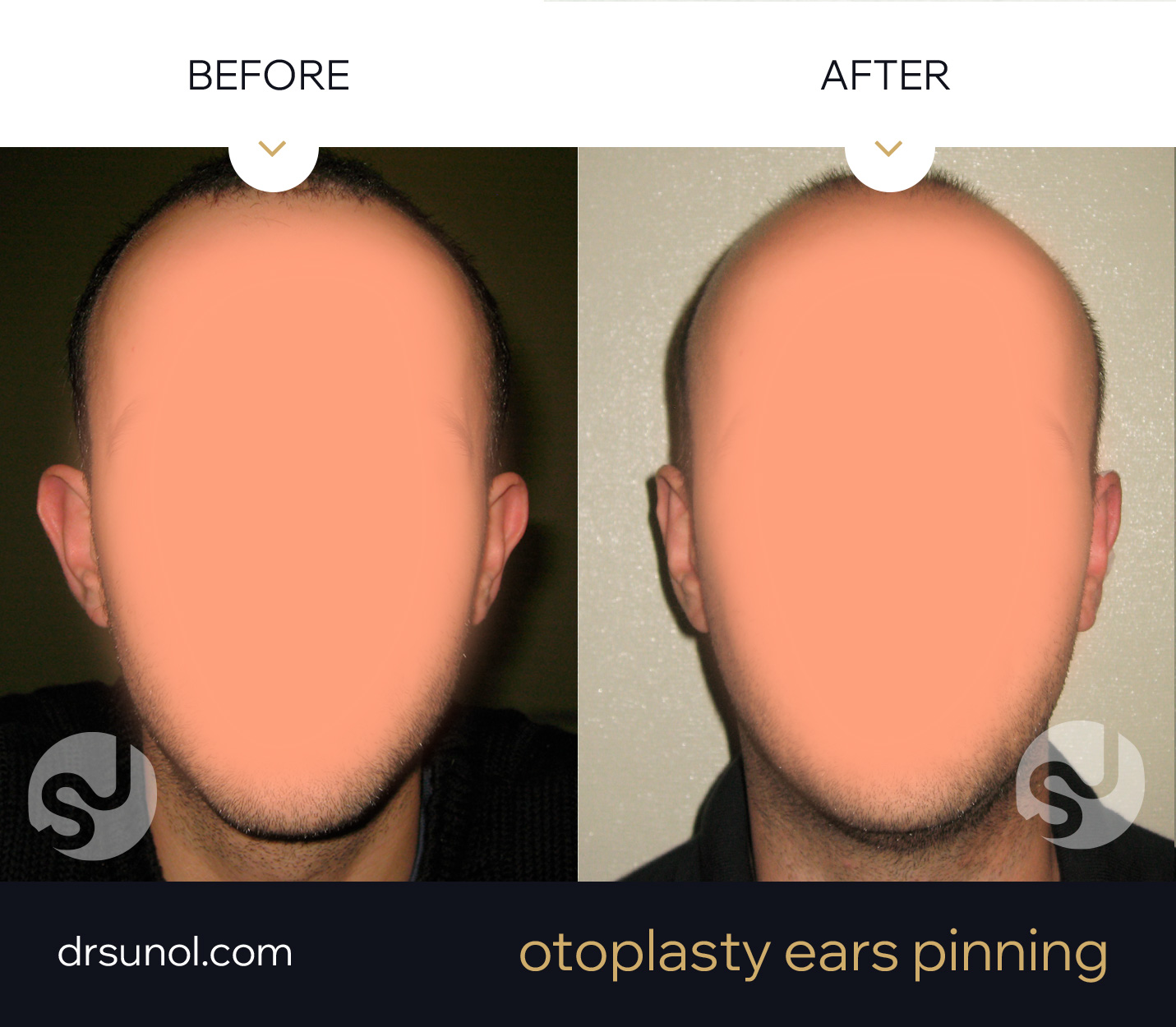 Otoplasty Ear Pinning Before Afer Example