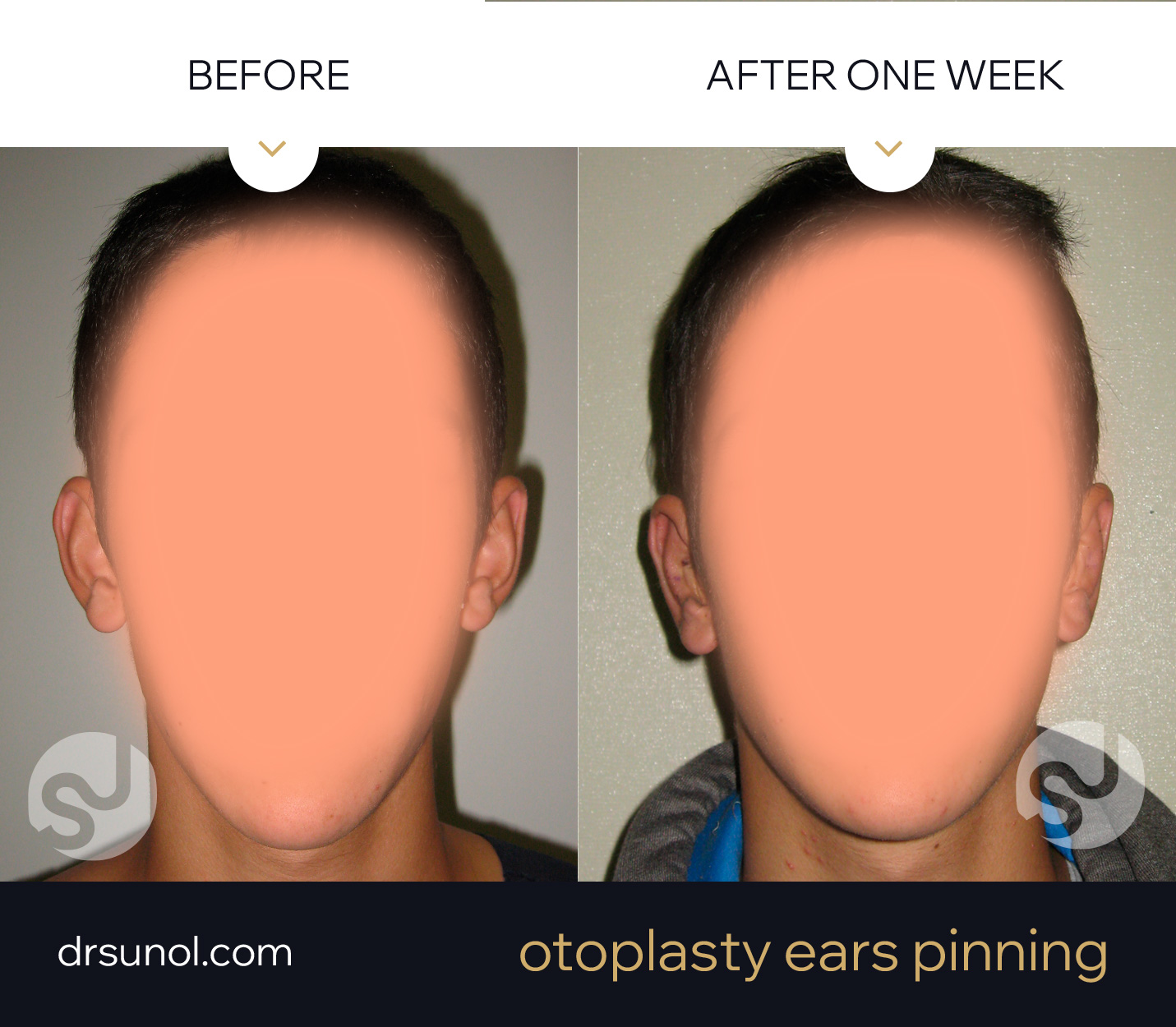 Otoplasty Ear Pinning Before Afer Example