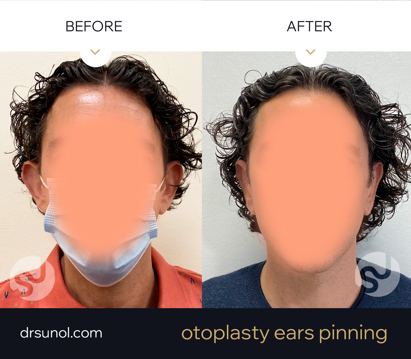 OOtoplasty Protruding Ears Before Afer
