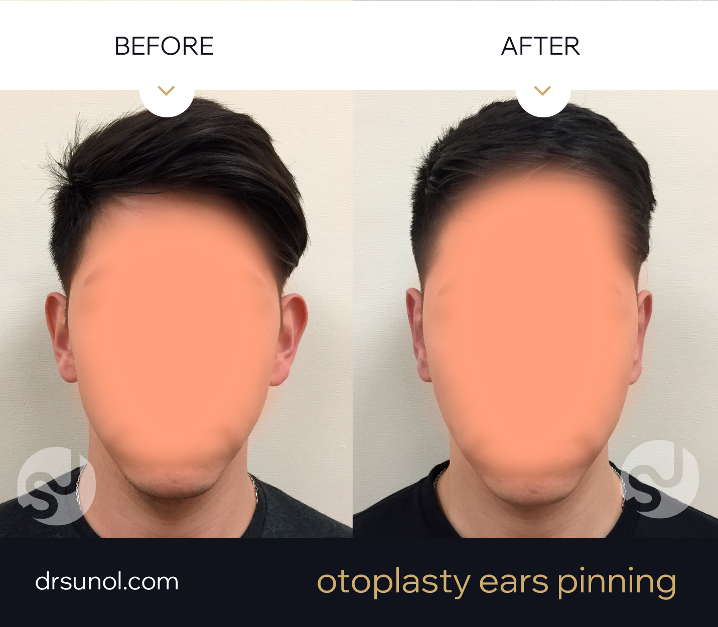 Otoplasty Protruding Ears