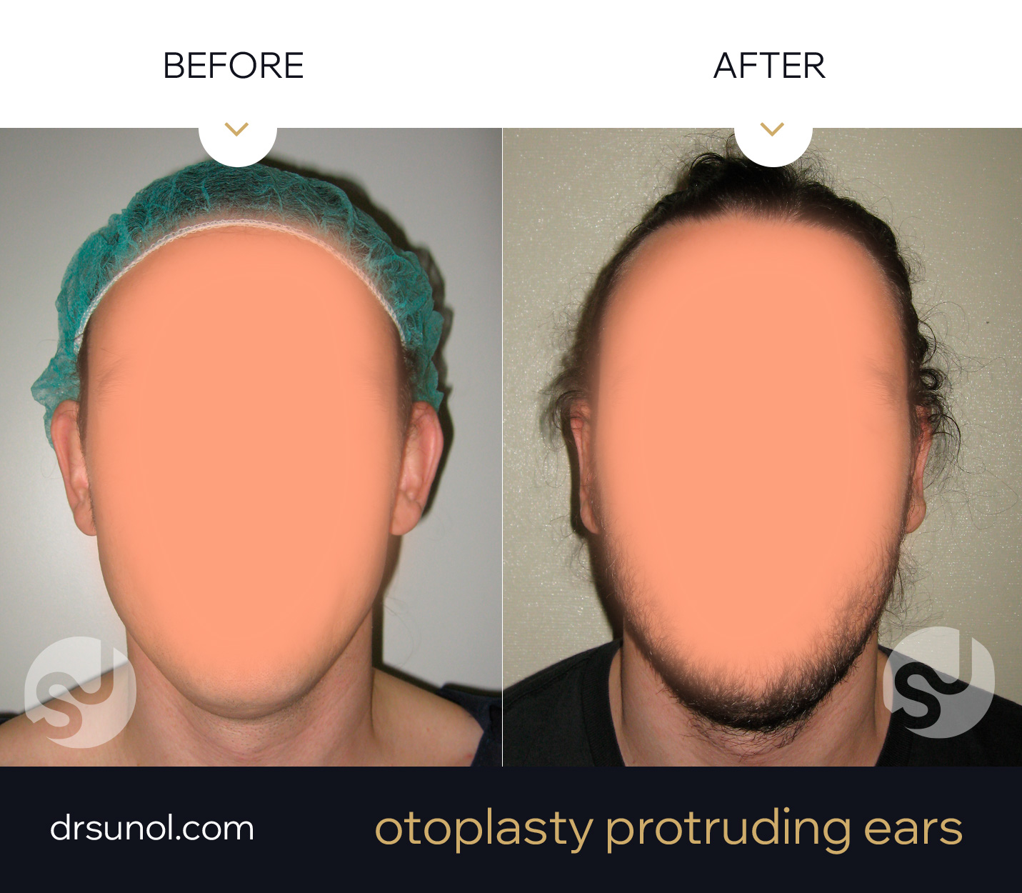 separated ears otoplasty results separated ears otoplasty results