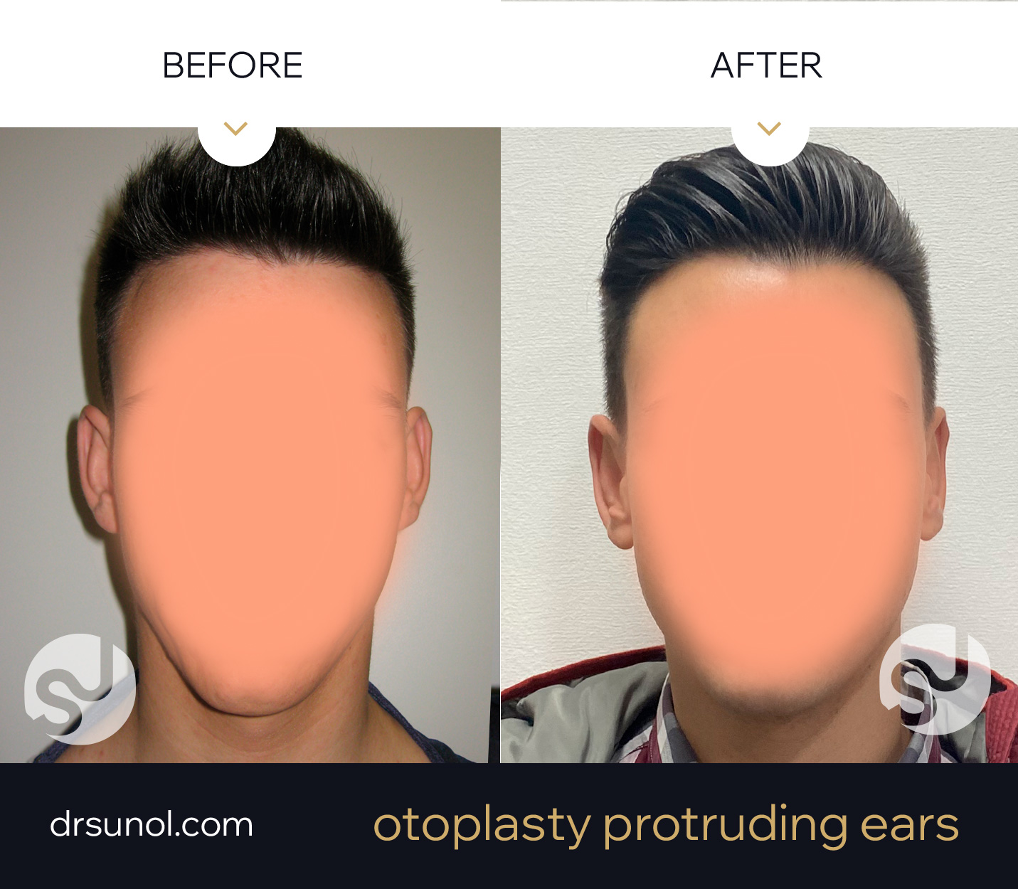 separated ears otoplasty example results separated ears otoplasty example results