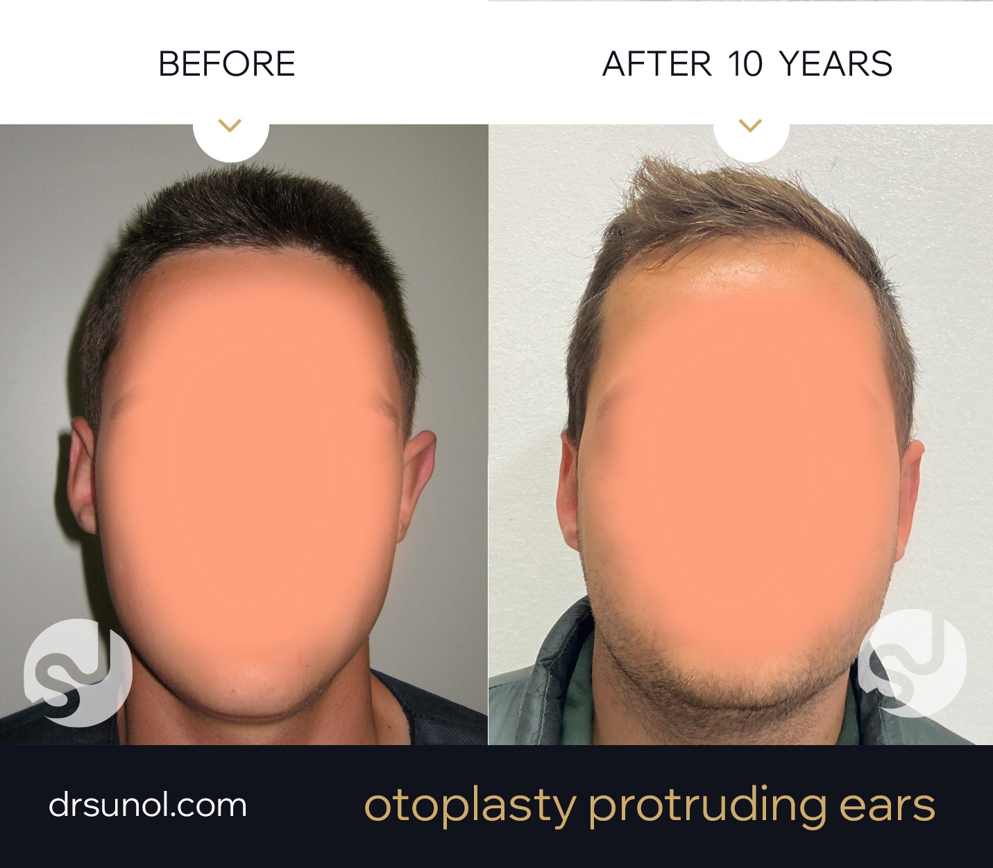 different ears before after otoplasty 