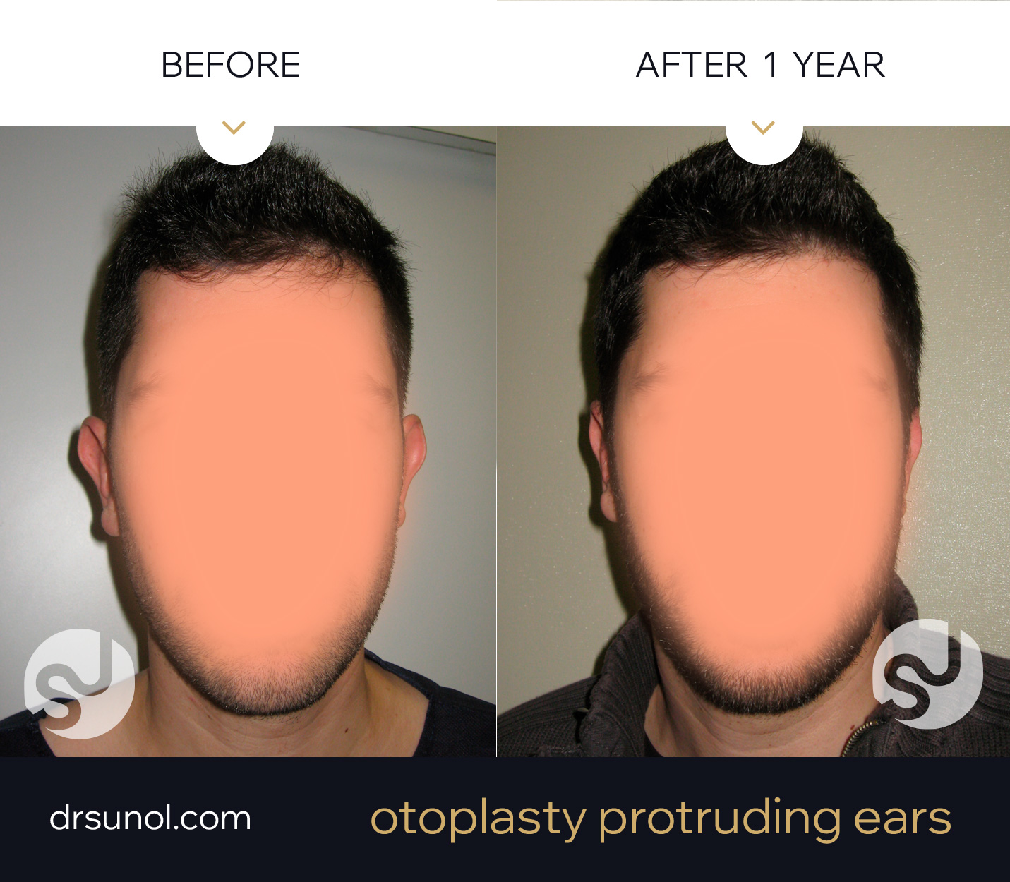 protruding ear otoplasty example of results protruding ear otoplasty example of results