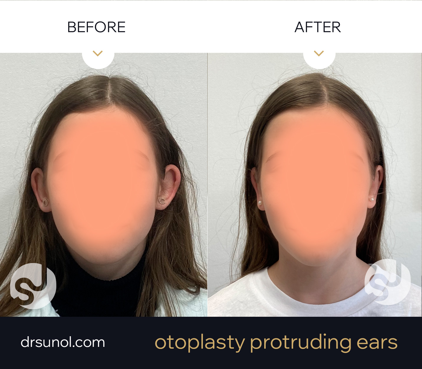 lop ear young girl results lop ear young girl results