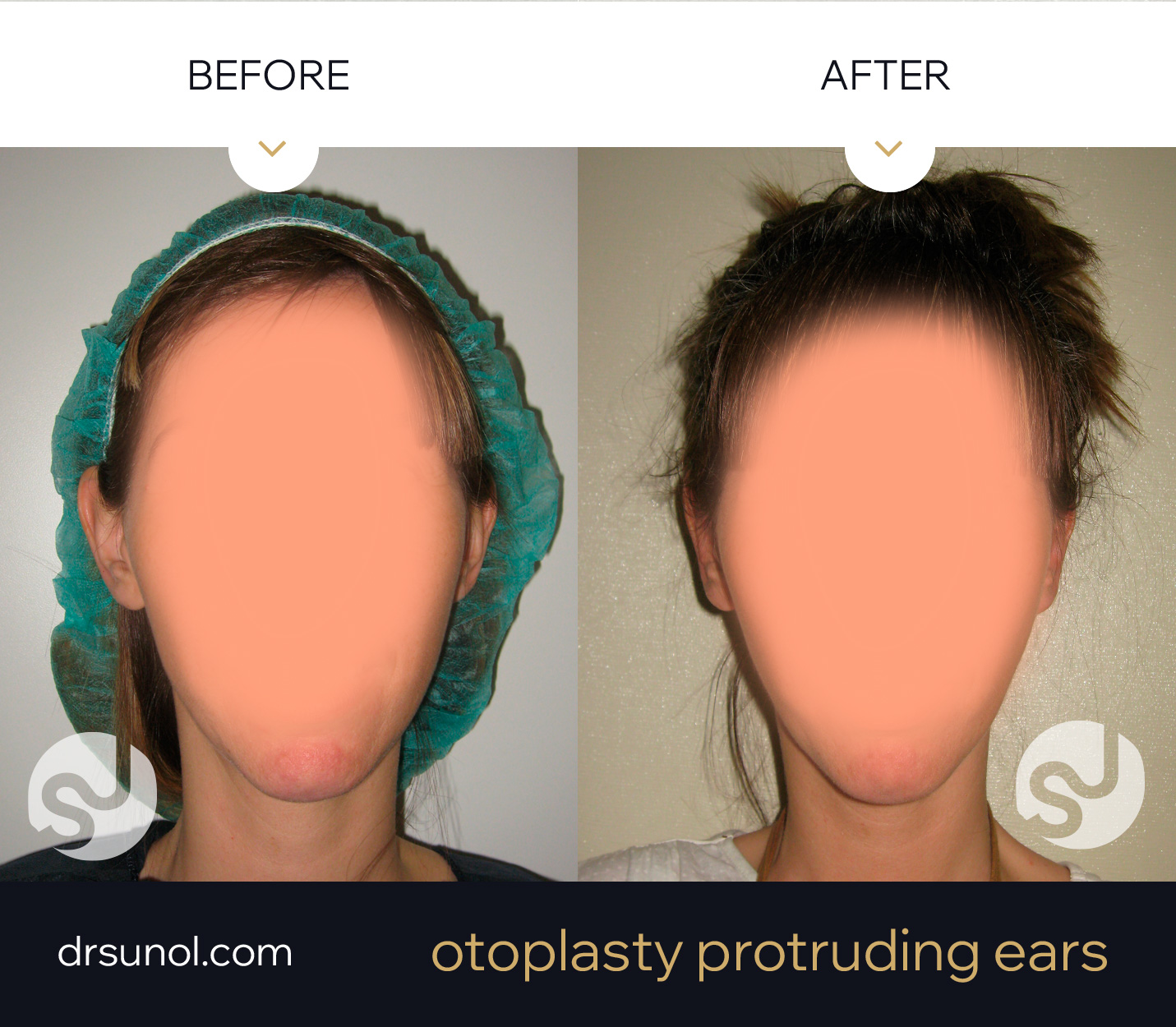 ear pinning results ear pinning results