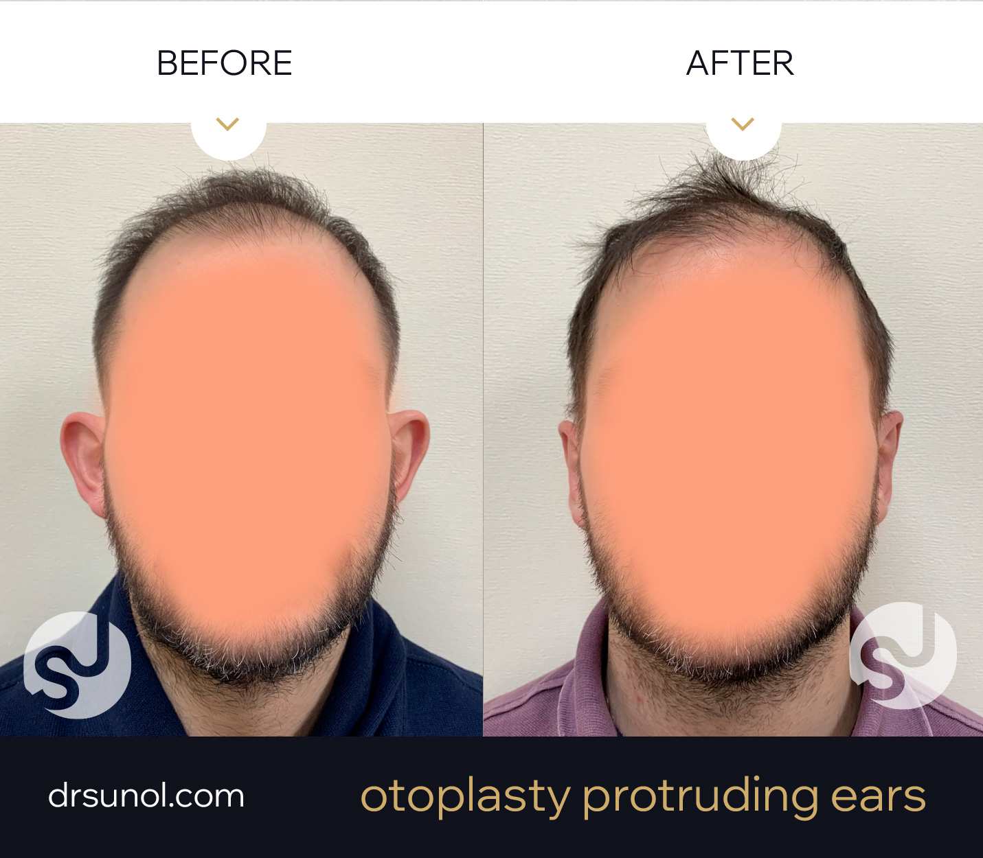 lop ear otoplasty results lop ear otoplasty results