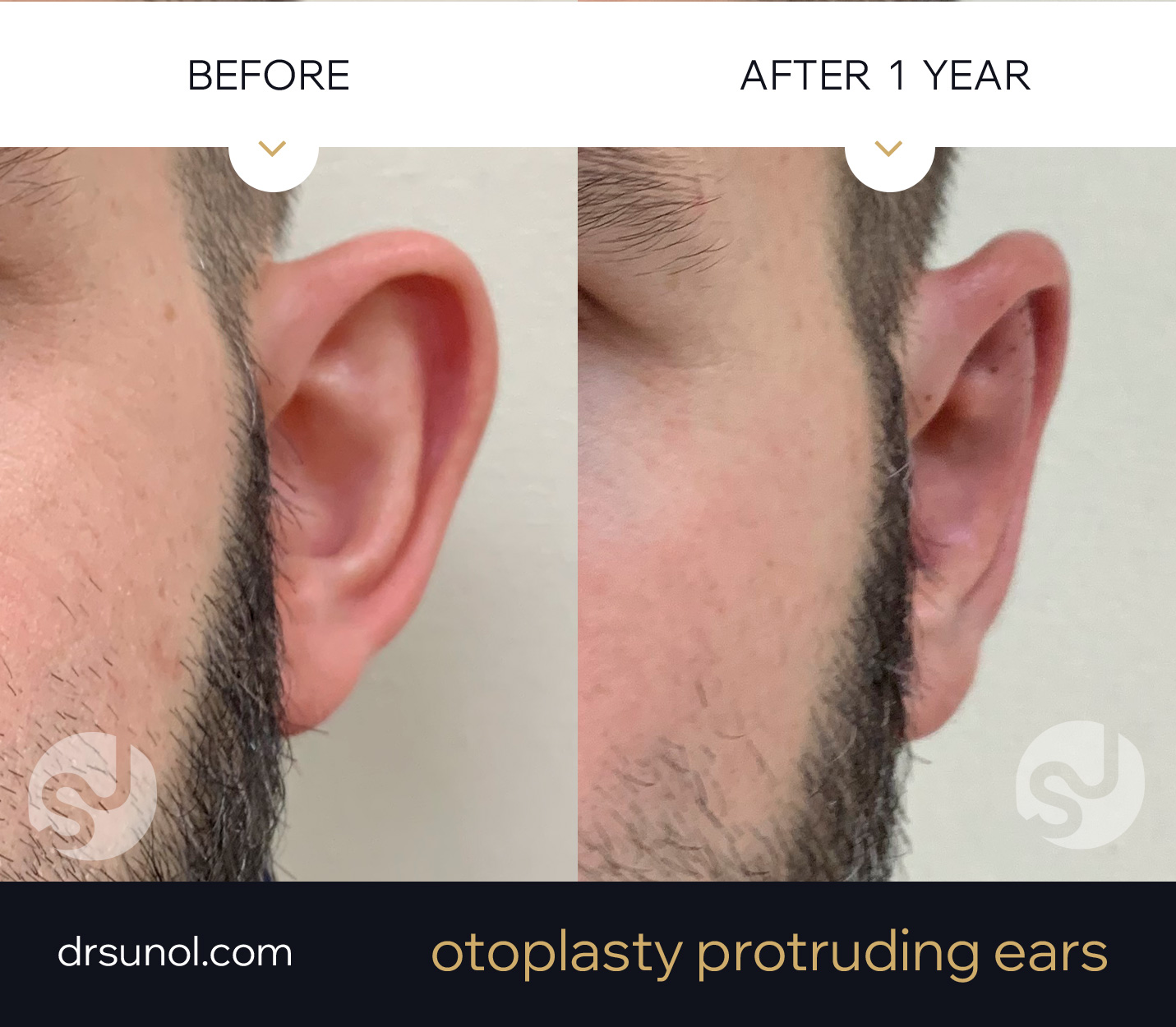 prominent ear closeup result prominent ear closeup result