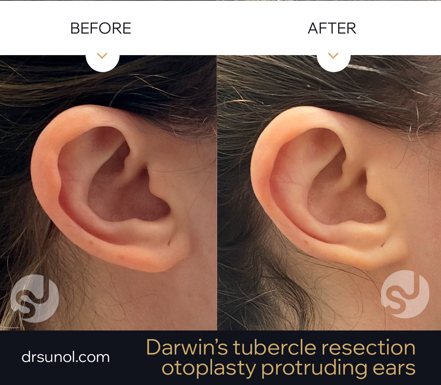 Darwin’s tubercle otoplasty example results Darwin's tubercle otoplasty example results