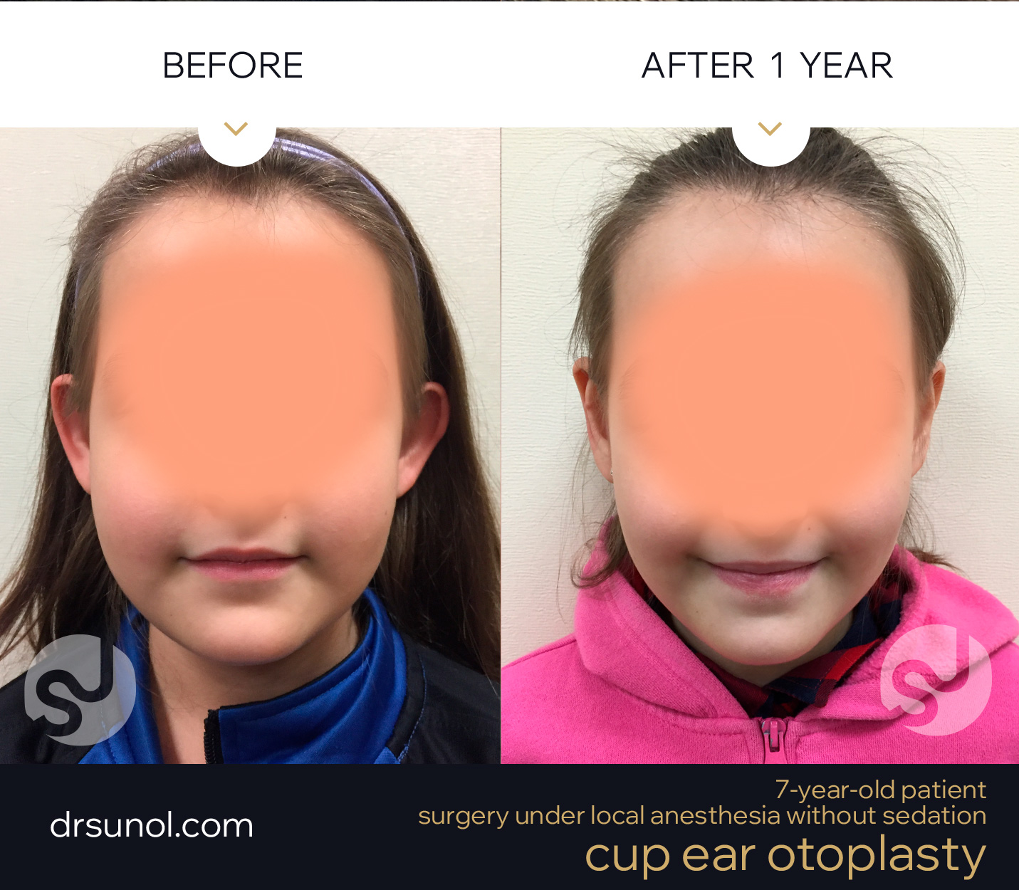 Cup ears pinning surgey on children with local anesthesia only Cup ears pinning surgey on children with local anesthesia only