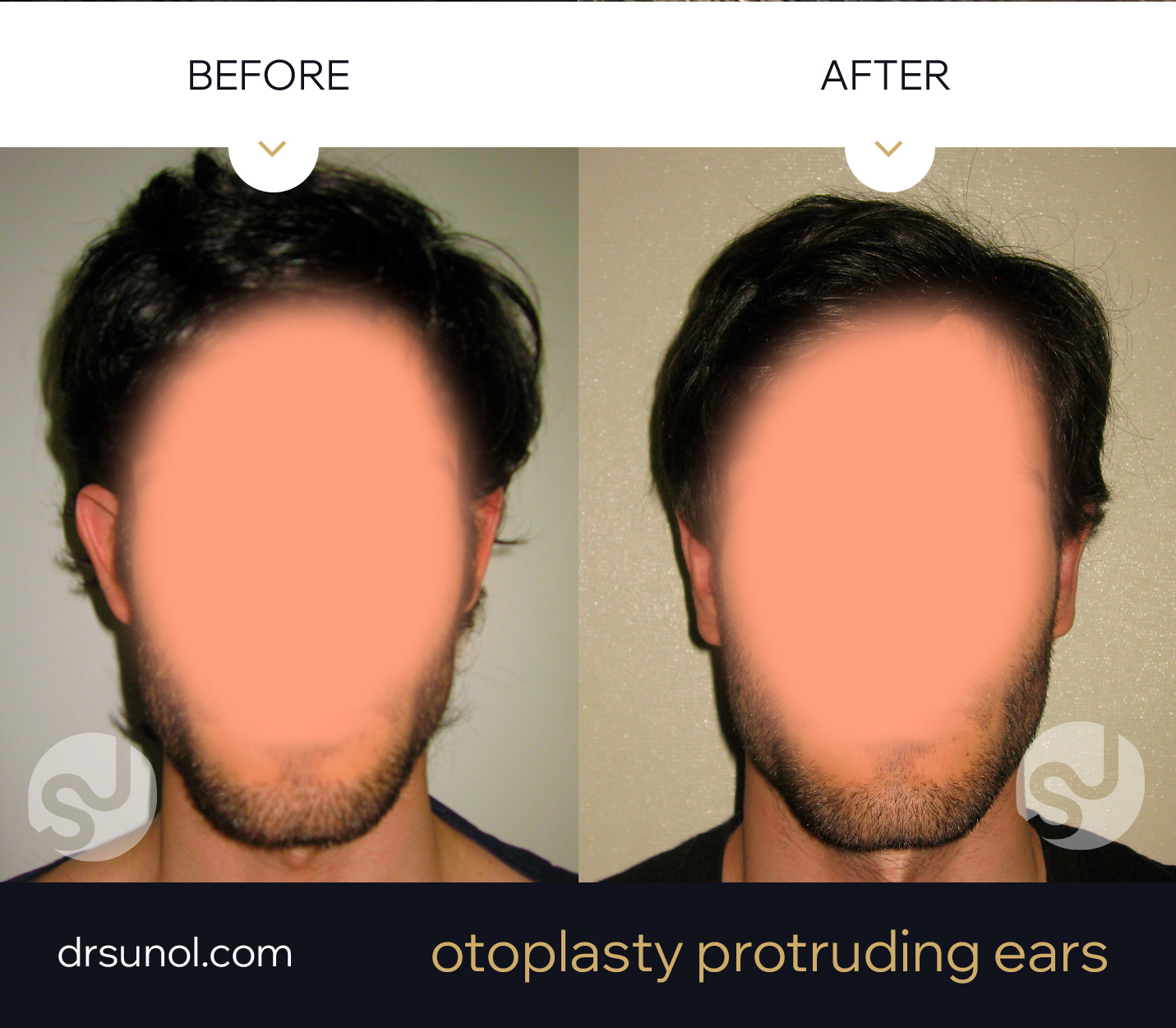 ear pinning before after ear pinning before after