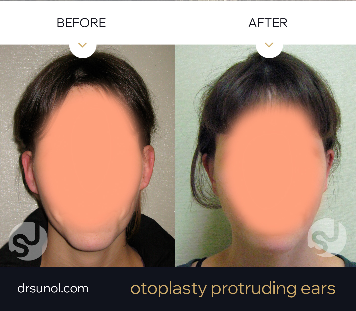 protruding ear otoplasty example protruding ear otoplasty example