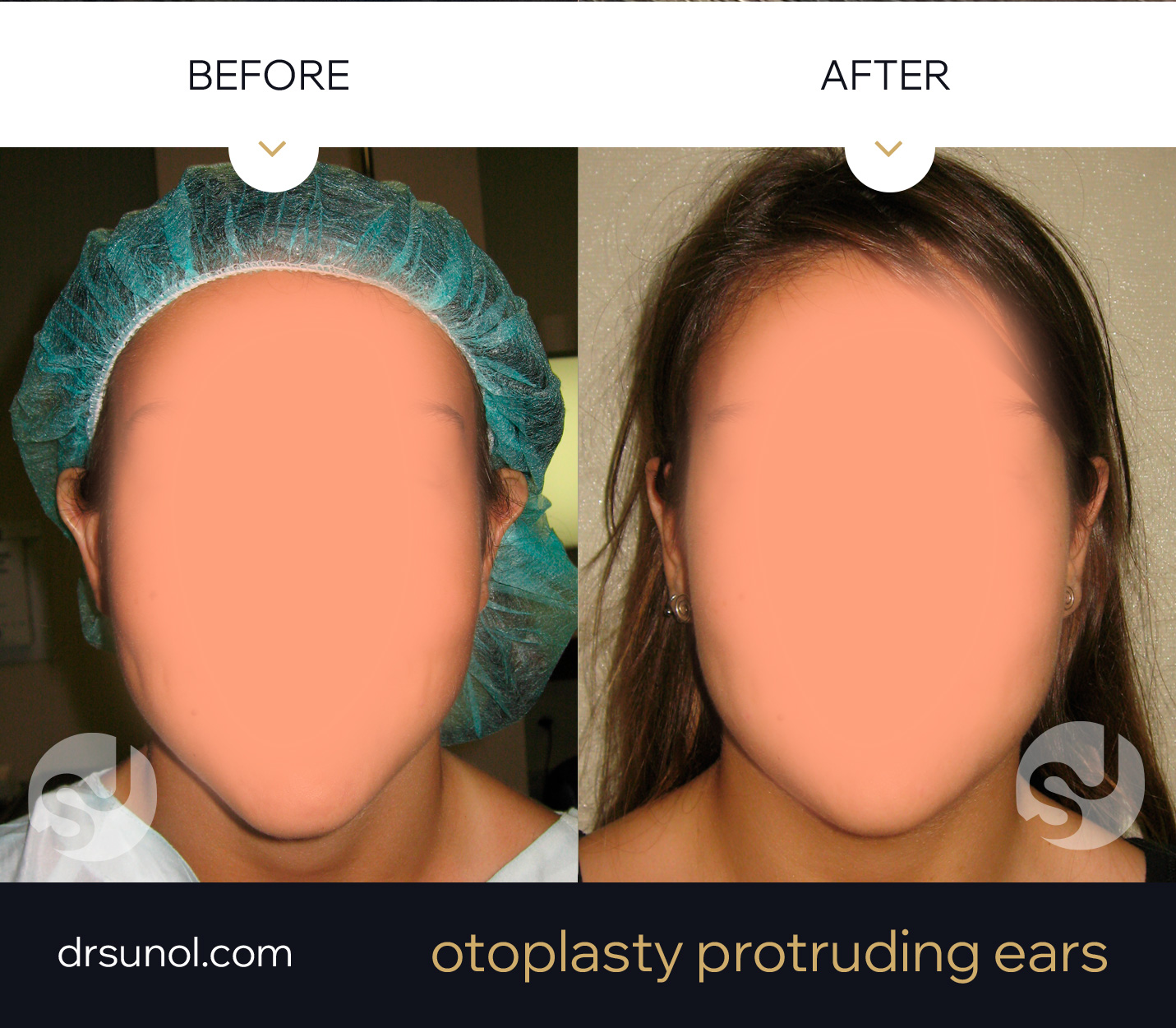 protruding ear otoplasty results protruding ear otoplasty results