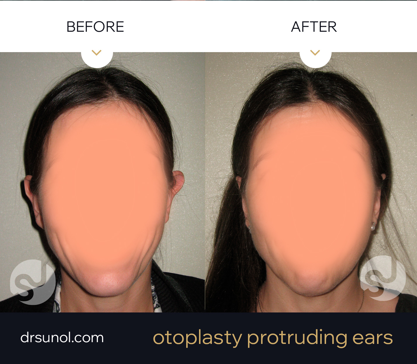Lop ears surgery results Lop ears surgery results