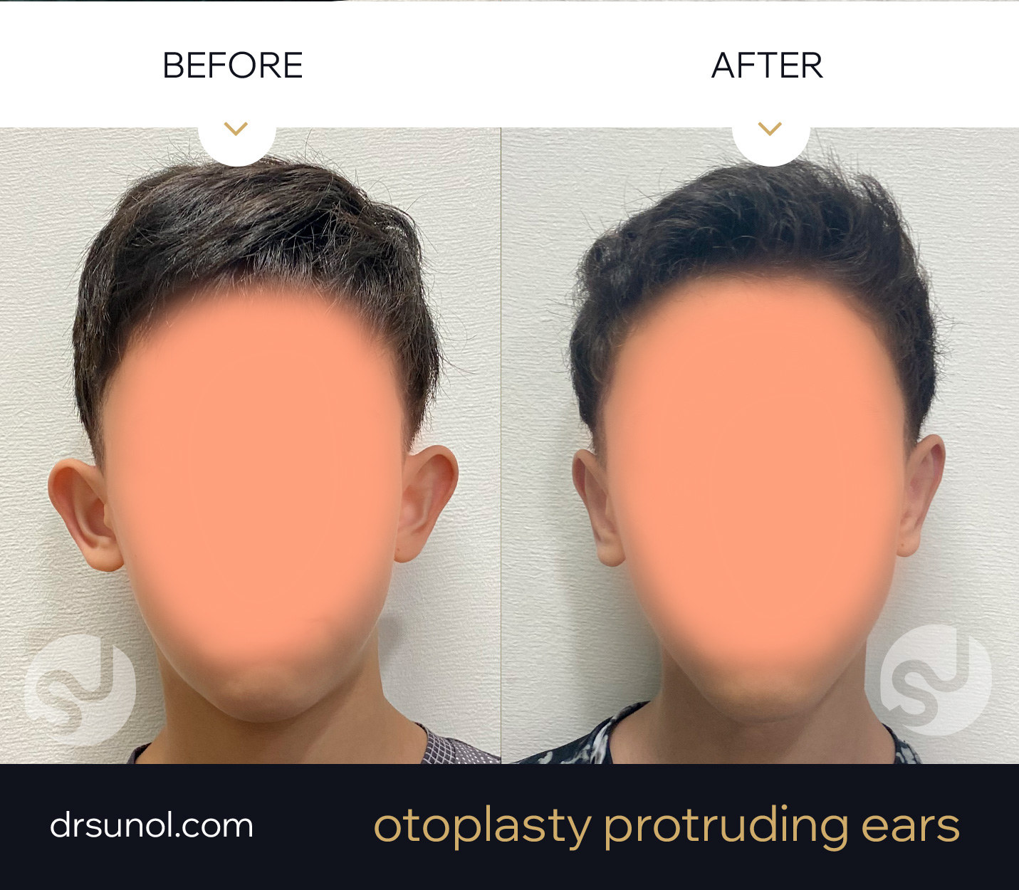 Young boy Otoplasty Results Young boy Otoplasty Results