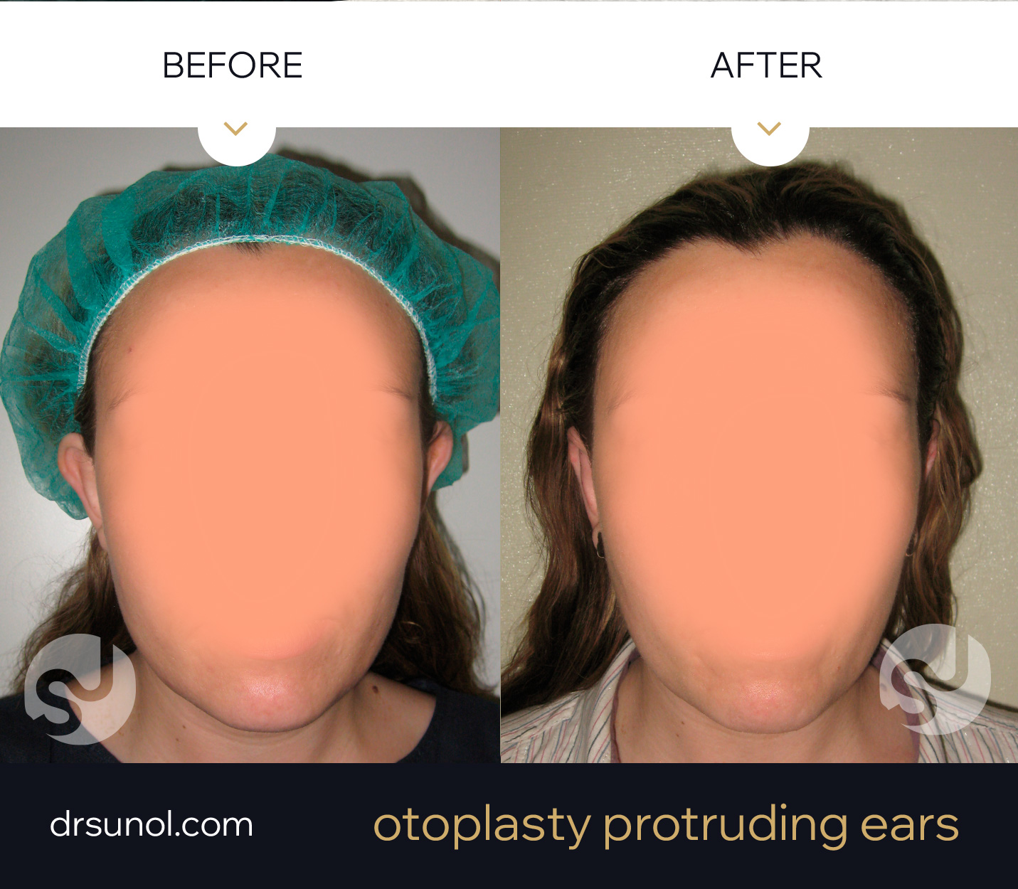 Otoplasty for Separated Ears Otoplasty for Separated Ears