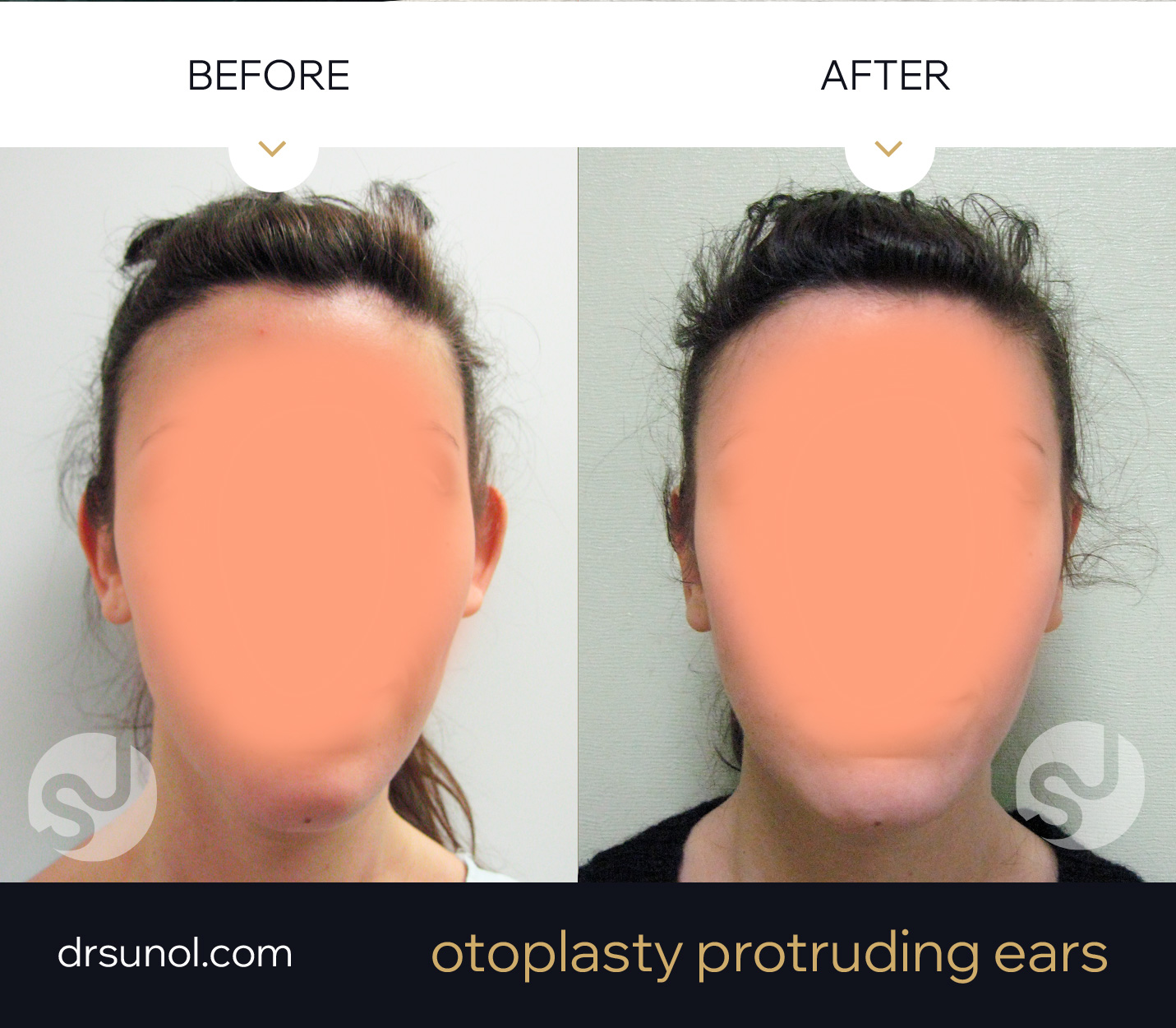 lop ear otoplasty results Lop ear otoplasty