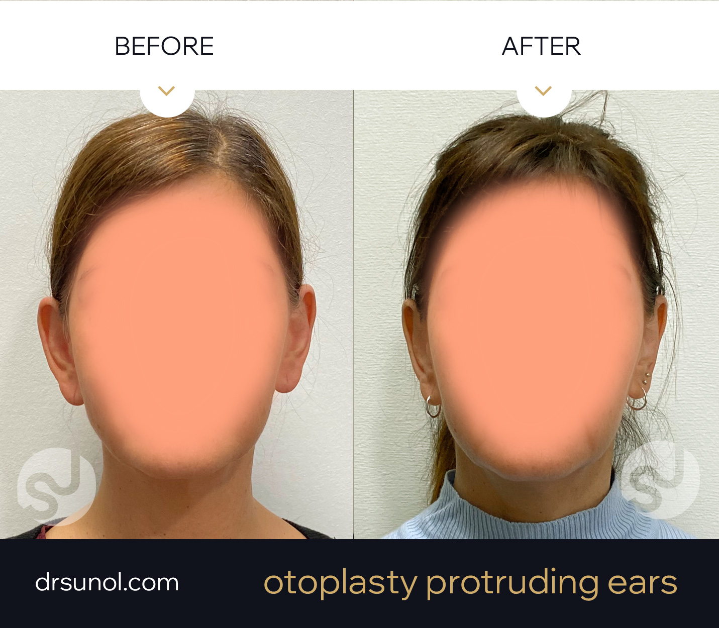 Otoplasty natural results Otoplasty natural results