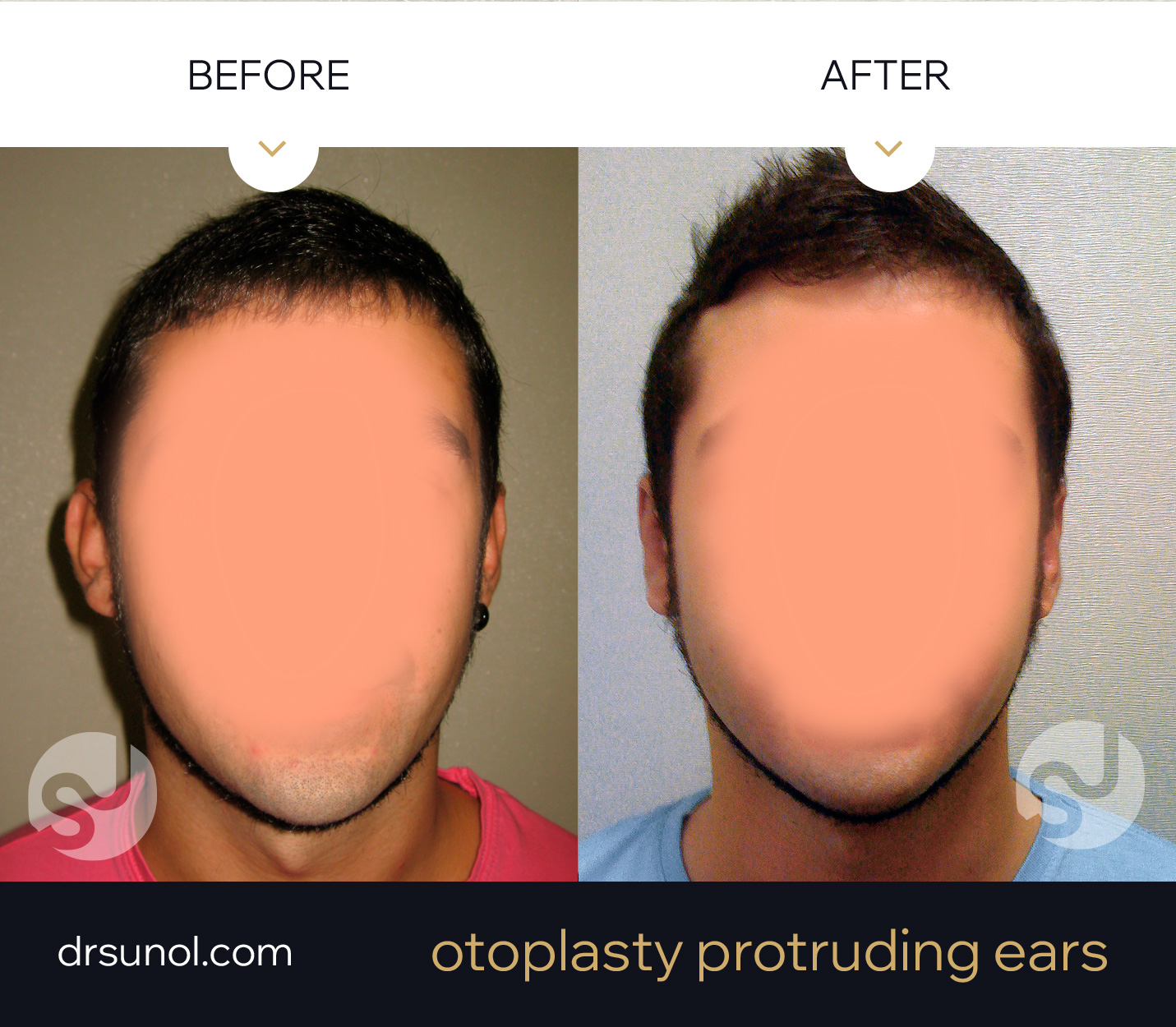 Prodruding Otoplasty before after Prodruding Otoplasty before after