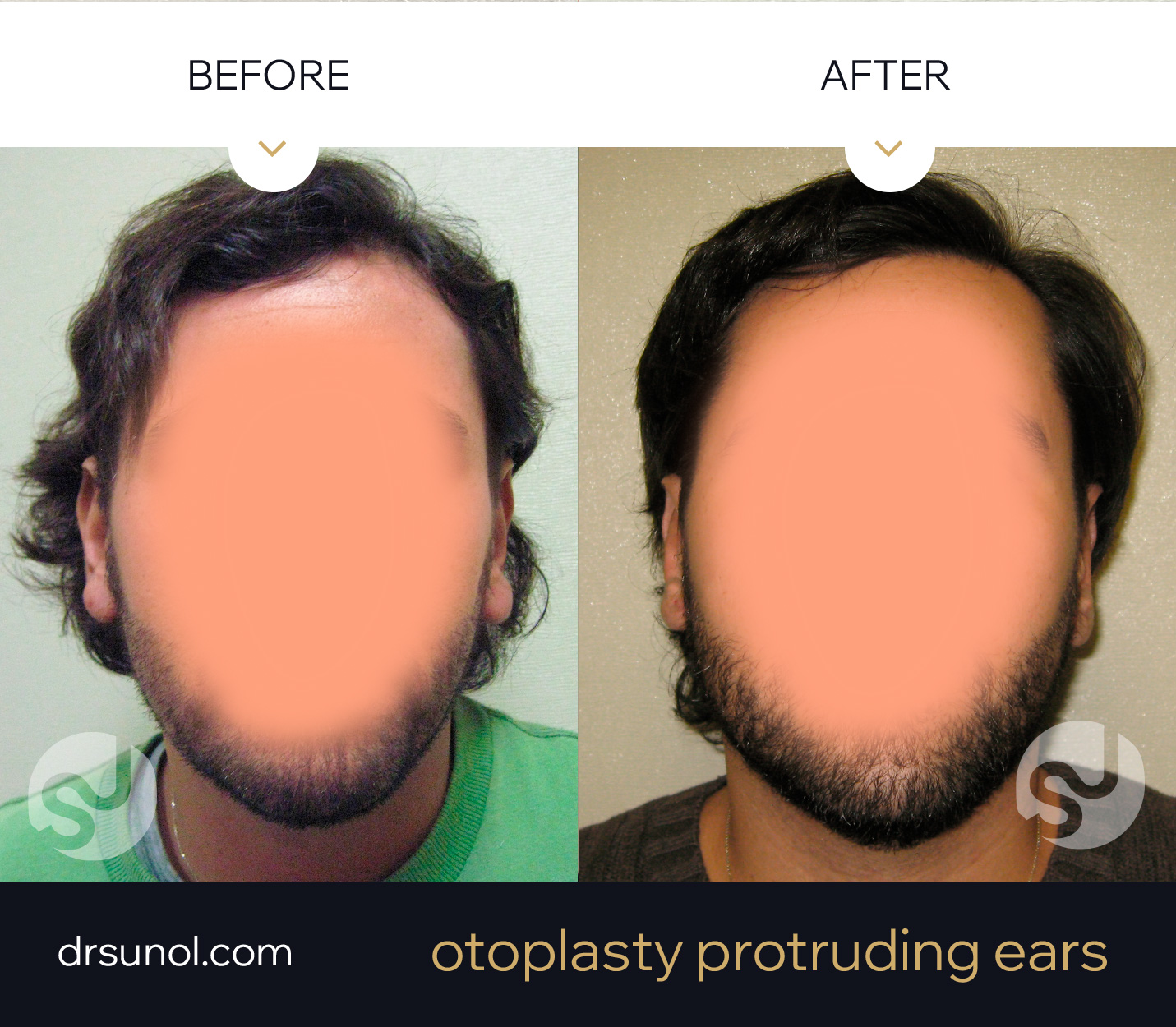Prodruding Ear surgery before after Prodruding Ear surgery before after