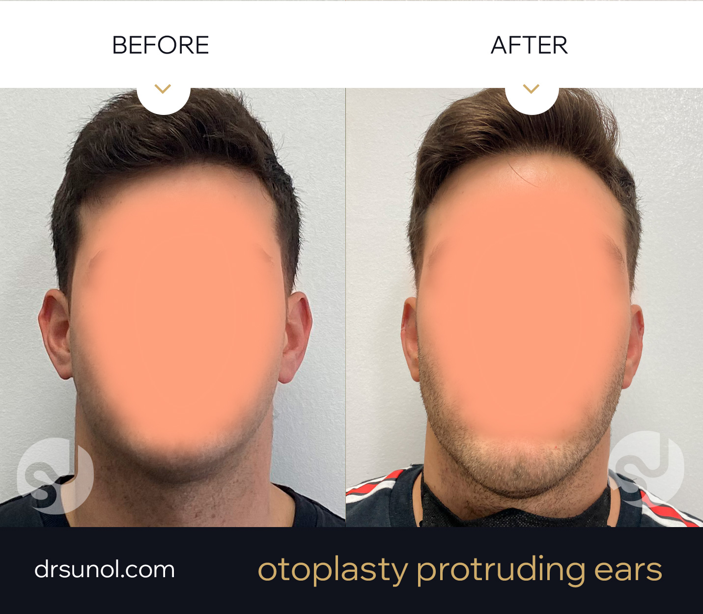 Prodruding Ear surgery results Prodruding Ear surgery results