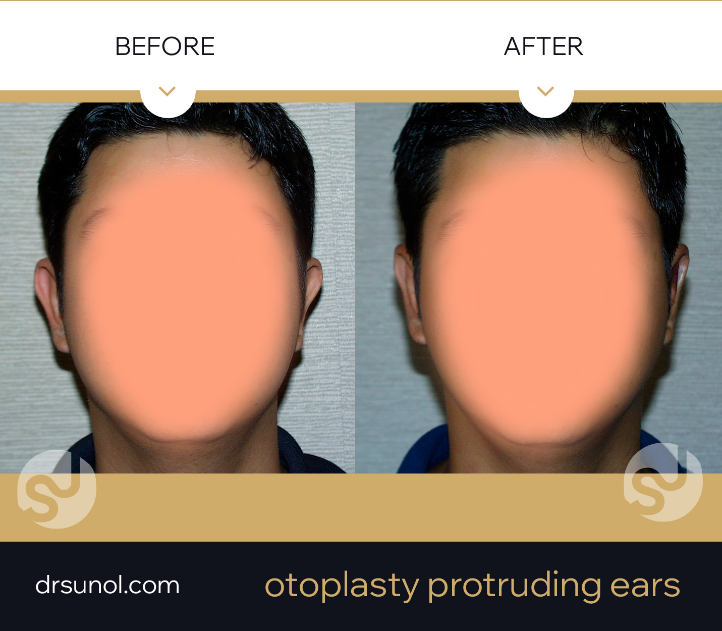 Otoplasty Before After Otoplasty Before After