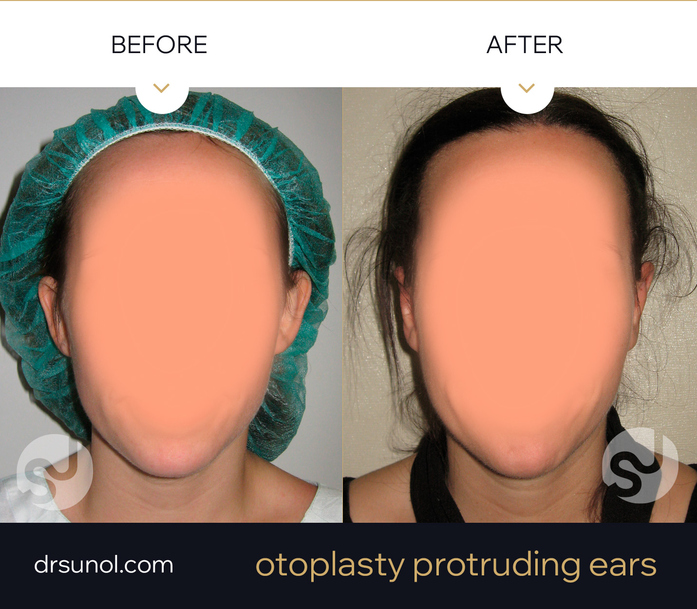 Otoplasty results Otoplasty results