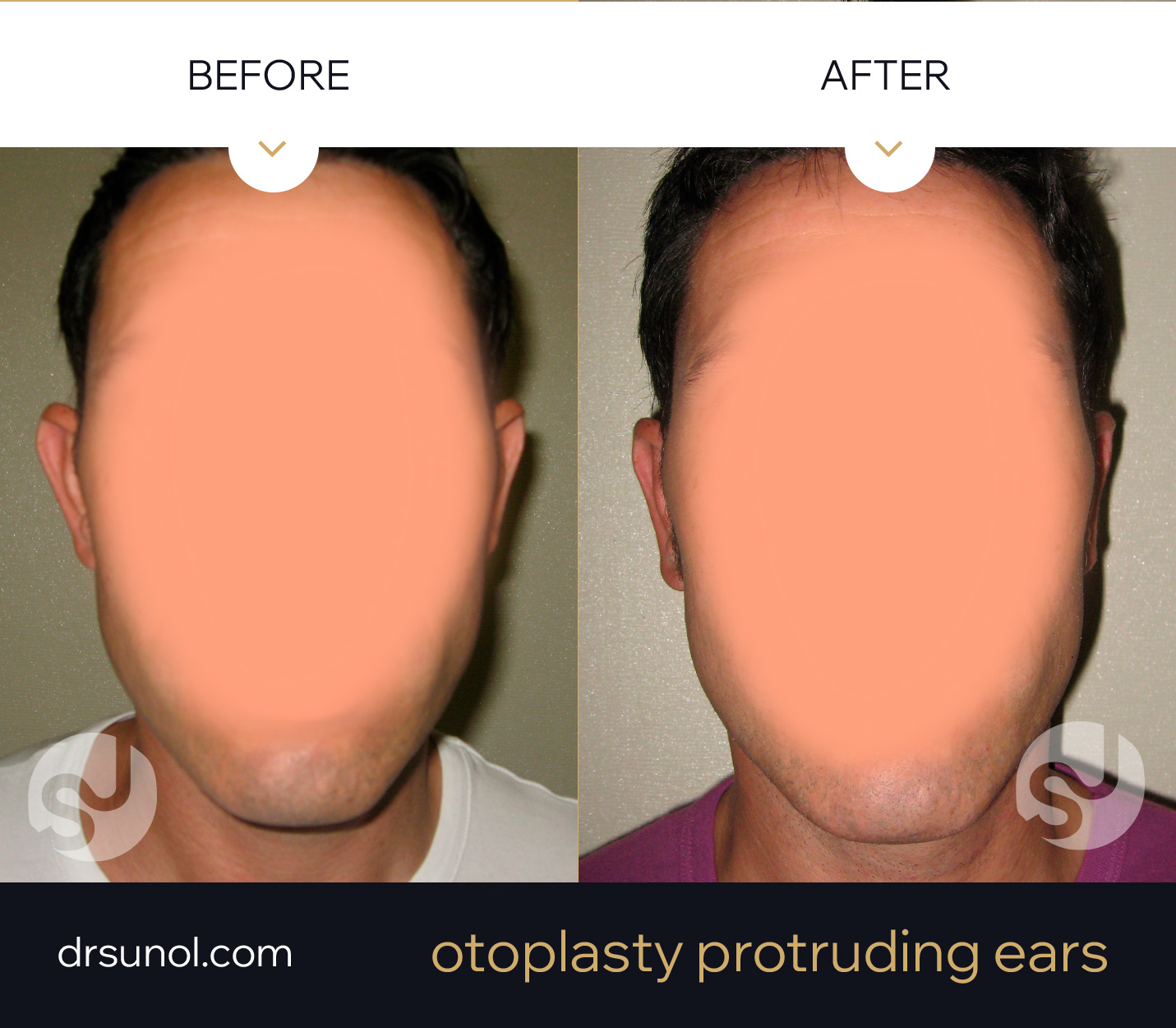 Ear pinning otoplasty results Ear pinning otoplasty results